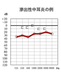 滲出性中耳炎のオージオグラム
