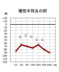 慢性中耳炎のオージオグラム