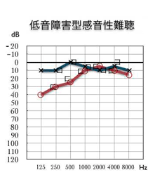 低音障害型感音難聴のオージオグラム