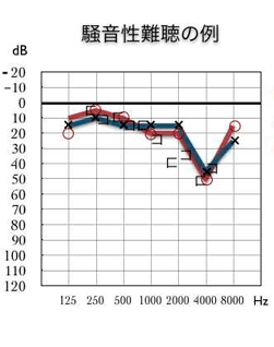 騒音性難聴のオージオグラム