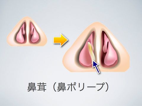 鼻茸