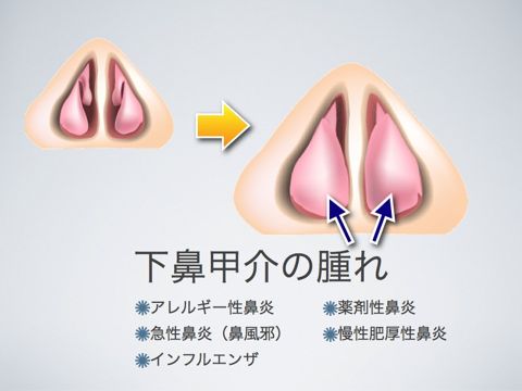 鼻炎のはなづまり