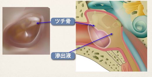 滲出性中耳炎の鼓膜