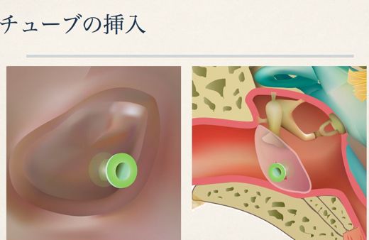 チュービング